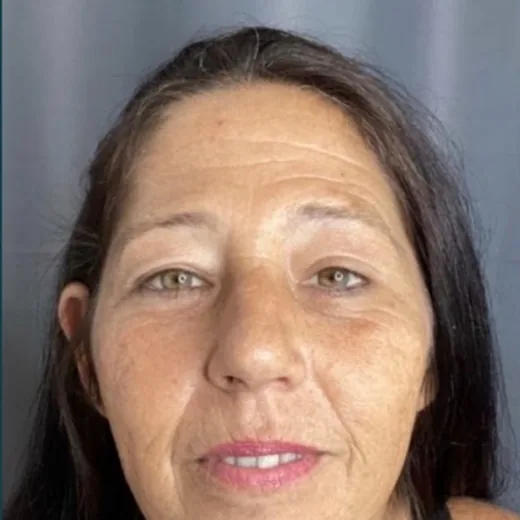 Antes — Botox